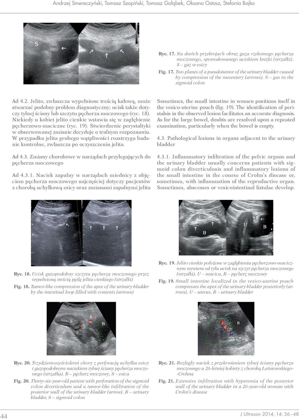 Jelito, zwłaszcza wypełnione treścią kałową, może stwarzać podobny problem diagnostyczny; ucisk także dotyczy tylnej ściany lub szczytu pęcherza moczowego (ryc. 18).