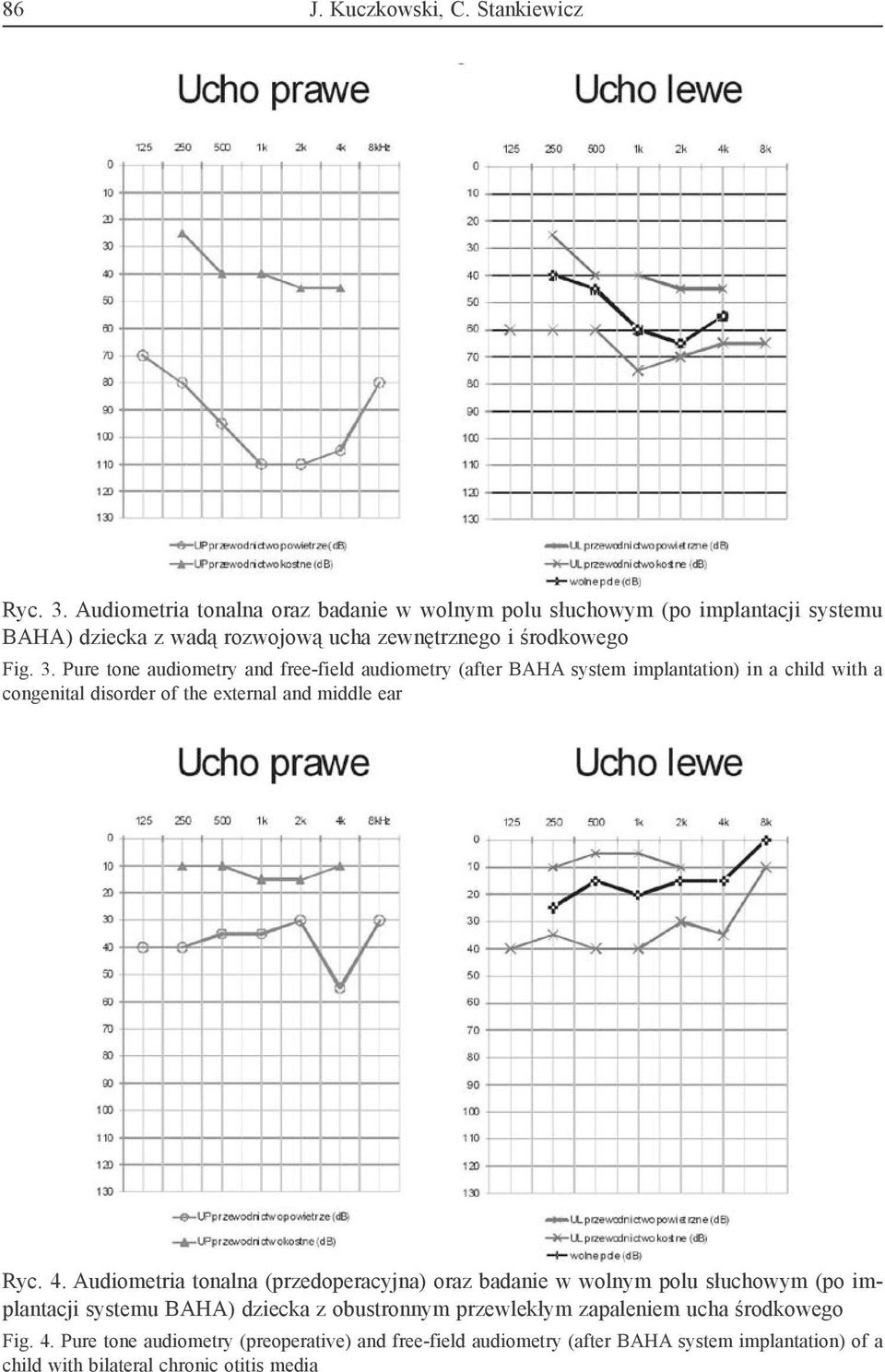 Pure tone audiometry and free-field audiometry (after BAHA system implantation) in a child with a congenital disorder of the external and middle ear Ryc. 4.