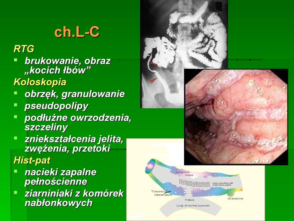 szczeliny zniekształcenia jelita, zwężenia, przetoki