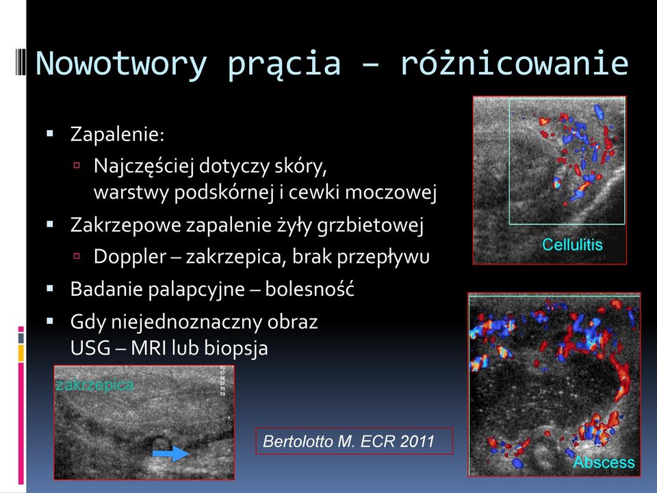 zakrzepica, brak przepływu Badanie palapcyjne bolesność Gdy niejednoznaczny