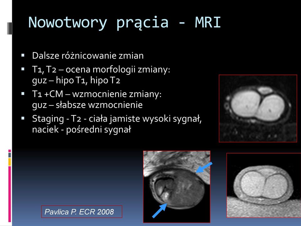 wzmocnienie zmiany: guz słabsze wzmocnienie Staging - T2 -