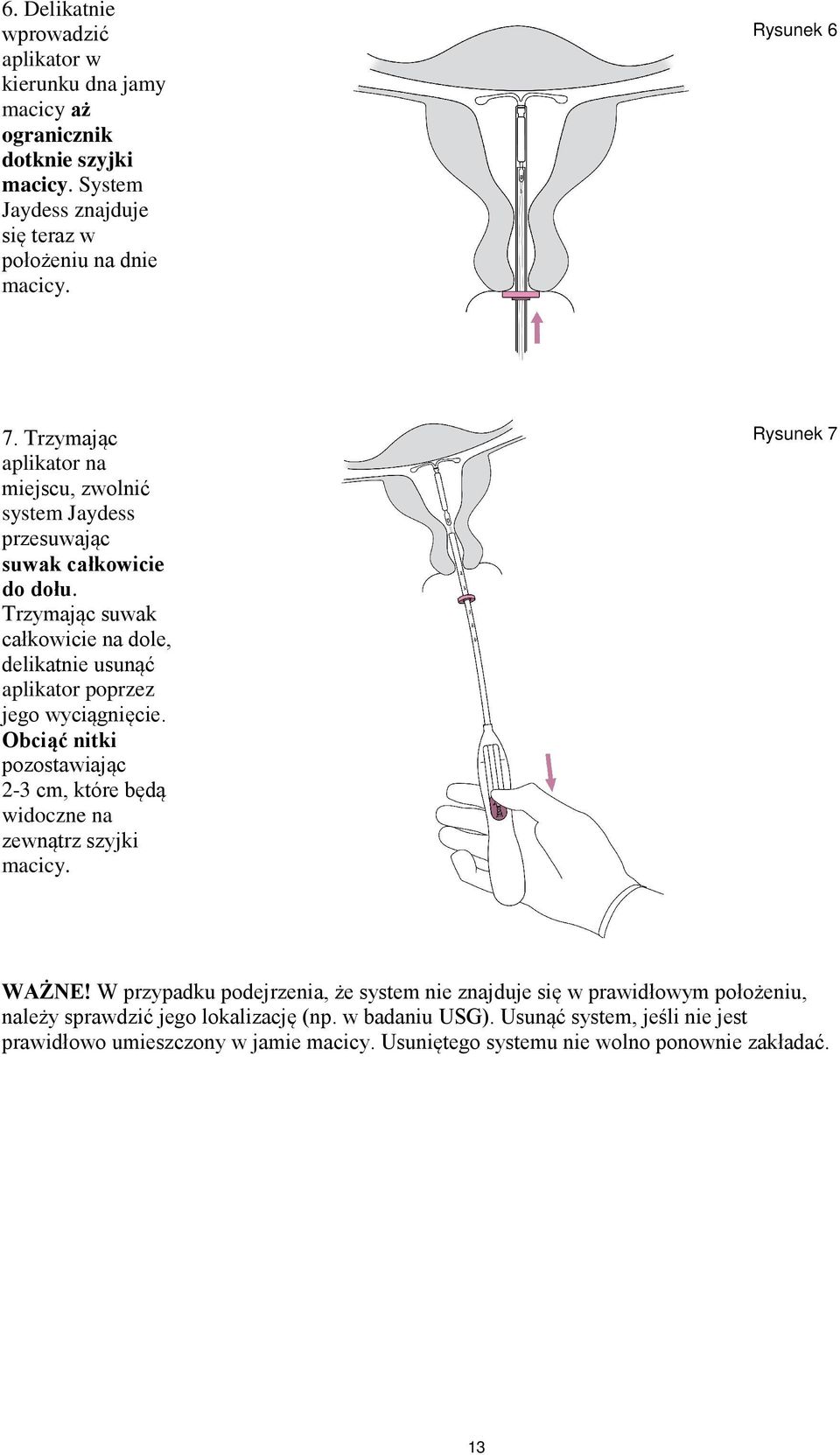 Trzymając suwak całkowicie na dole, delikatnie usunąć aplikator poprzez jego wyciągnięcie. Obciąć nitki pozostawiając 2-3 cm, które będą widoczne na zewnątrz szyjki macicy.