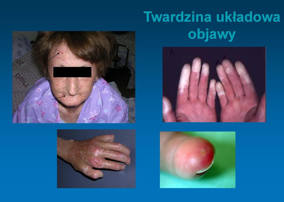 objawy