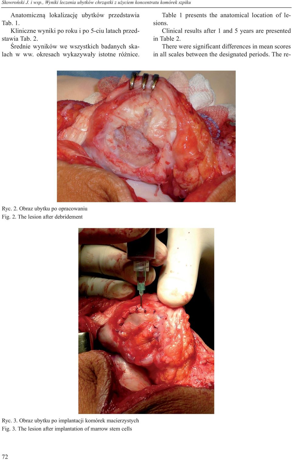 Średnie wyników we wszystkich badanych skalach w ww. okresach wykazywały istotne różnice. Ryc. 2. Obraz ubytku po opracowaniu Fig. 2. The lesion after debridement Ryc. 3.