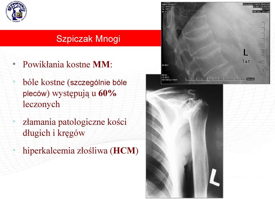 u 60% leczonych złamania patologiczne kości