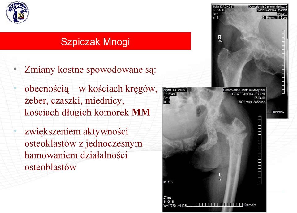 miednicy, kościach długich komórek MM zwiększeniem