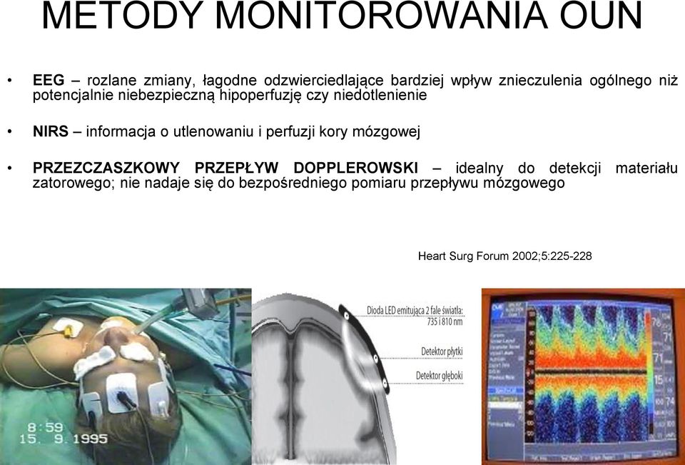 utlenowaniu i perfuzji kory mózgowej PRZEZCZASZKOWY PRZEPŁYW DOPPLEROWSKI idealny do detekcji
