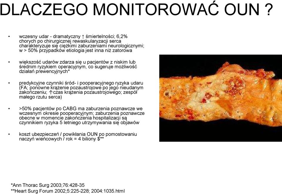 zatorowa większość udarów zdarza się u pacjentów z niskim lub średnim ryzykiem operacyjnym, co sugeruje możliwość działań prewencyjnych* predykcyjne czynniki śród- i pooperacyjnego ryzyka udaru (FA;