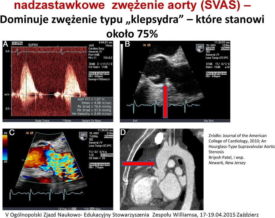 American College of Cardiology, 2010; An Hourglass-Type