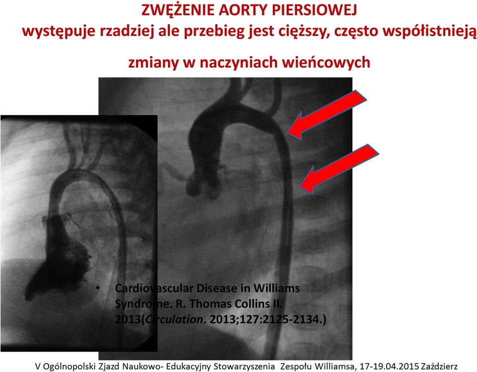 wieńcowych Cardiovascular Disease in Williams Syndrome. R.