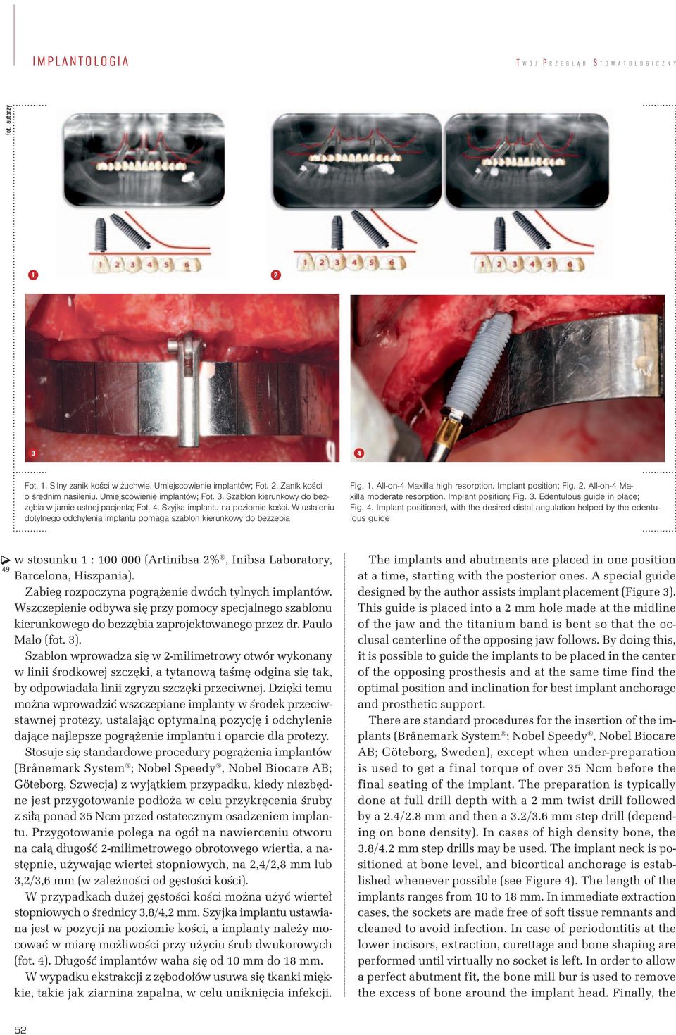 W ustaleniu dotylnego odchylenia implantu pomaga szablon kierunkowy do bezzębia Fig. 1. All-on-4 Maxilla high resorption. Implant position; Fig. 2. All-on-4 Maxilla moderate resorption.