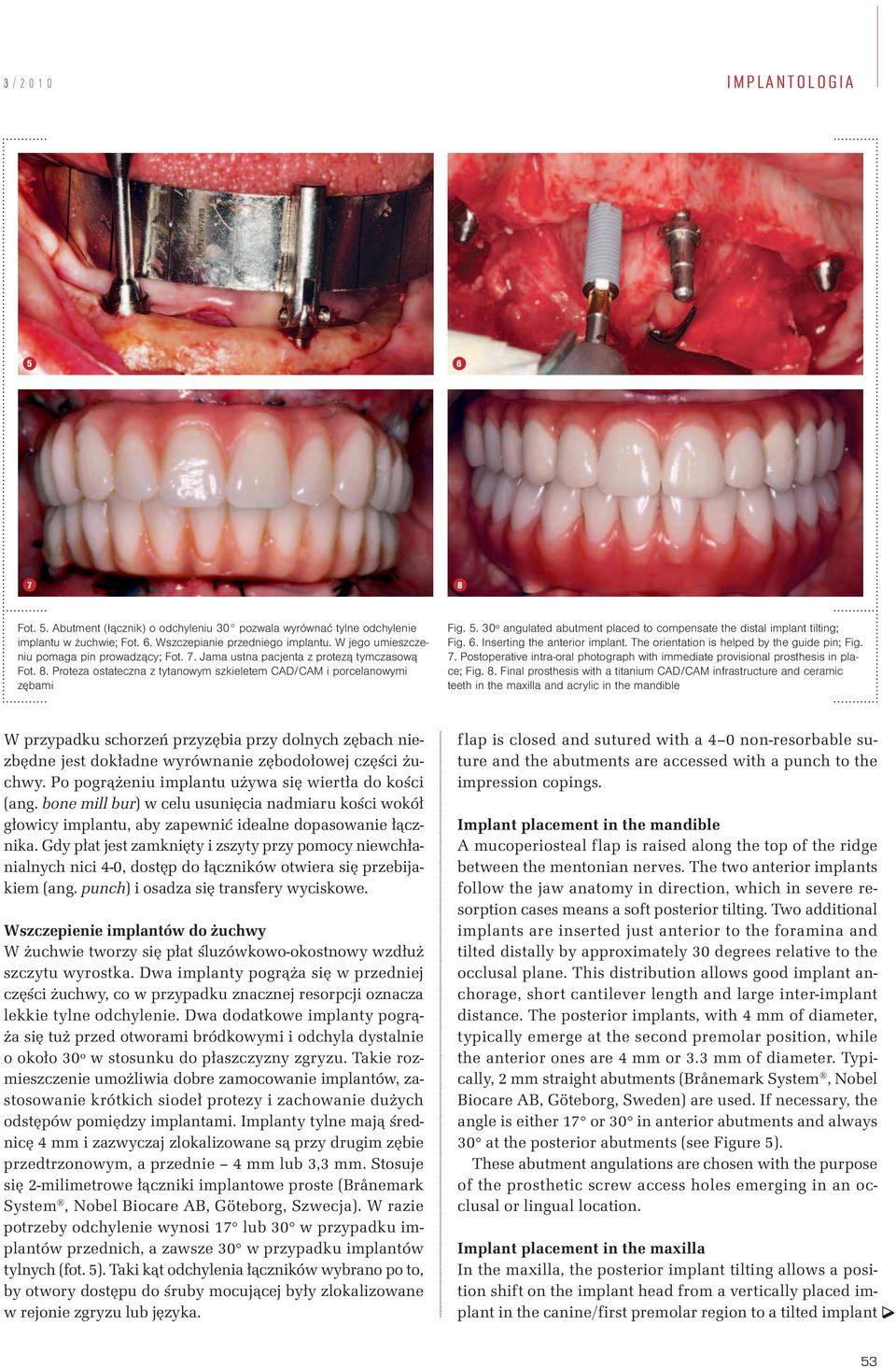 30º angulated abutment placed to compensate the distal implant tilting; Fig. 6. Inserting the anterior implant. The orientation is helped by the guide pin; Fig. 7.