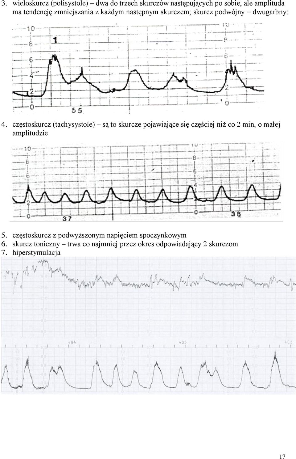 częstoskurcz (tachysystole) są to skurcze pojawiające się częściej niż co 2 min, o małej amplitudzie 5.