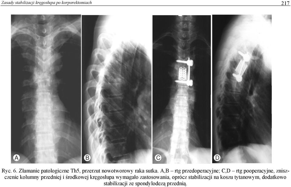 A,B rtg przedoperacyjne; C,D rtg pooperacyjne, zniszczenie kolumny przedniej i