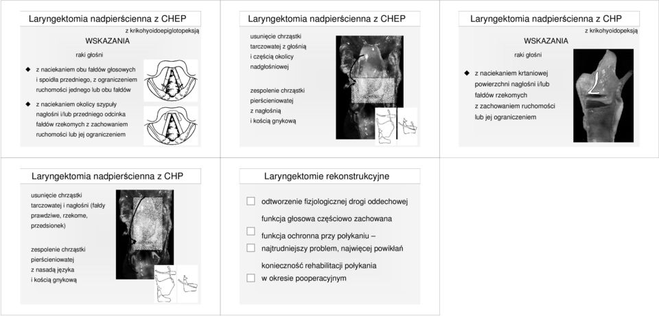 głośnią i częścią okolicy nadgłośniowej zespolenie chrząstki pierścieniowatej z nagłośnią i kością gnykową Laryngektomia nadpierścienna z CHP z krikohyoidopeksją WSKAZANIA raki głośni z naciekaniem