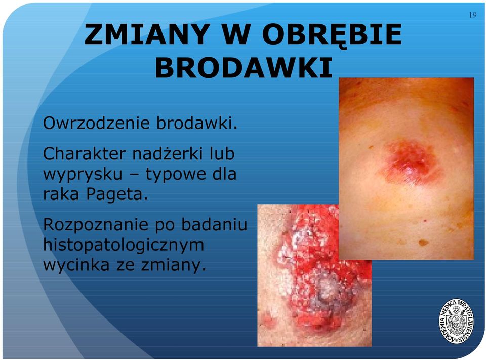 Charakter nadżerki lub wyprysku typowe
