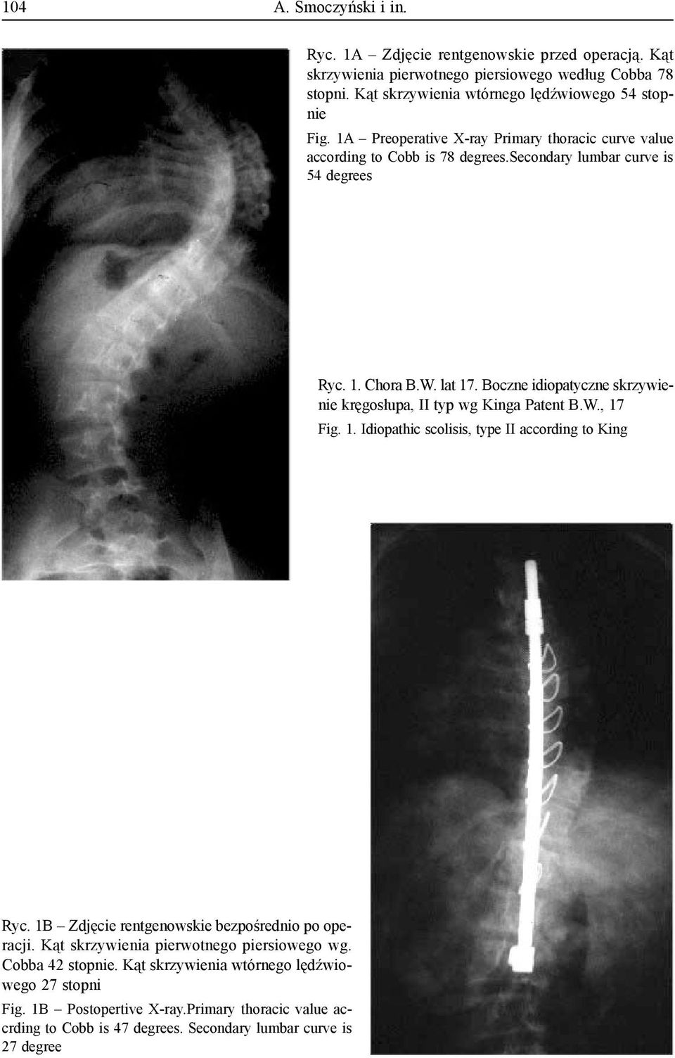 Boczne idiopatyczne skrzywienie kręgosłupa, II typ wg Kinga Patent B.W., 17 Fig. 1. Idiopathic scolisis, type II according to King Ryc. 1B Zdjęcie rentgenowskie bezpośrednio po operacji.