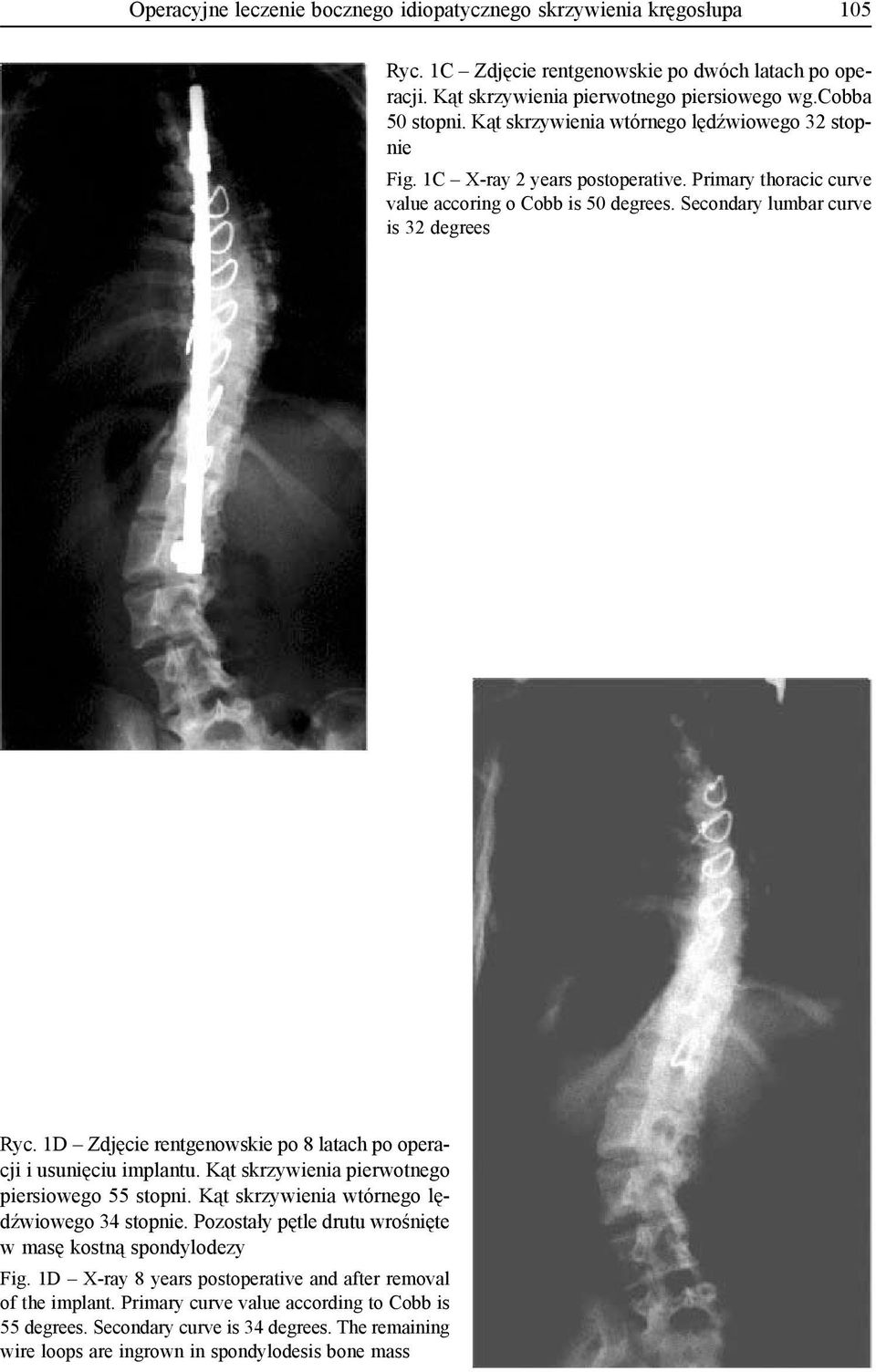 1D Zdjęcie rentgenowskie po 8 latach po operacji i usunięciu implantu. Kąt skrzywienia pierwotnego piersiowego 55 stopni. Kąt skrzywienia wtórnego lędźwiowego 34 stopnie.