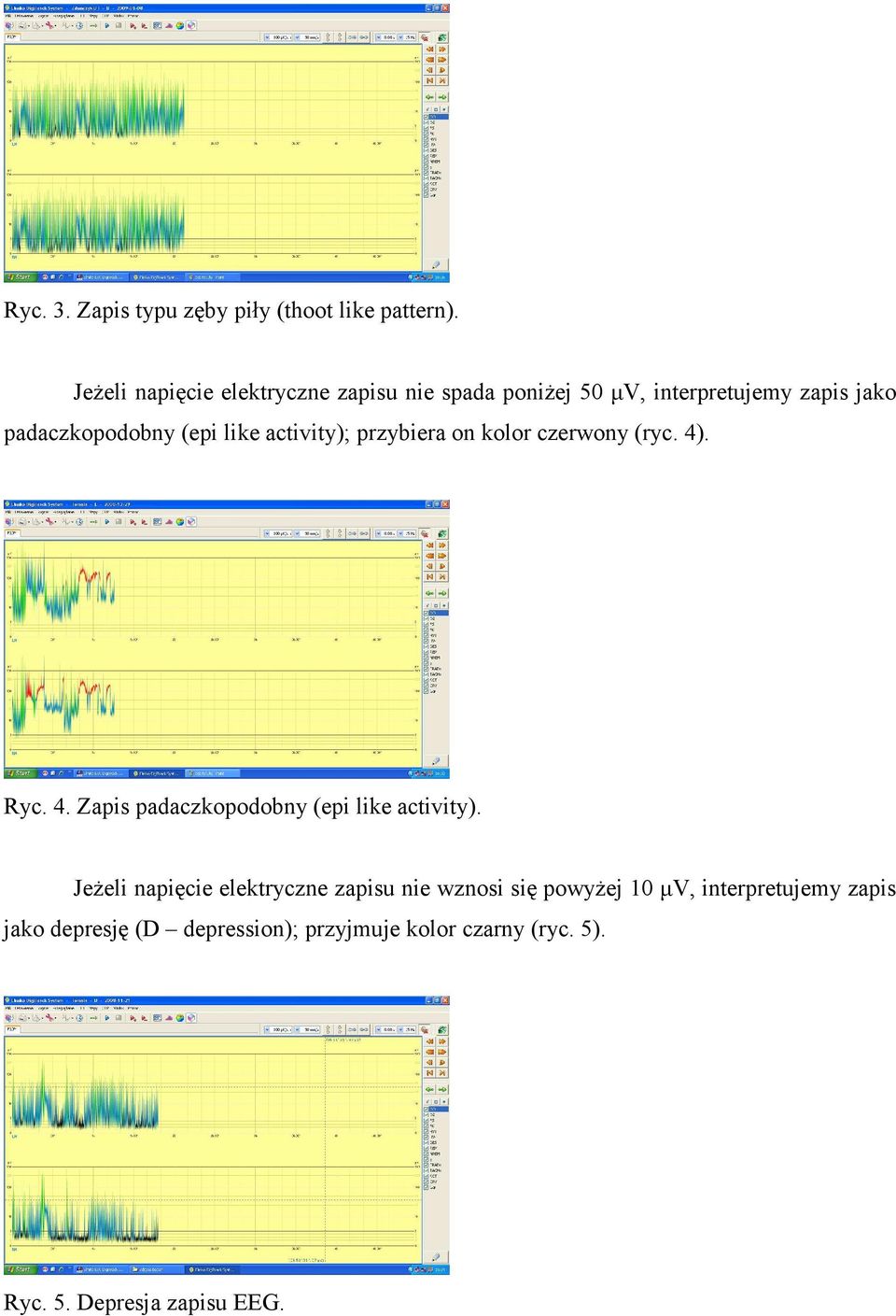 like activity); przybiera on kolor czerwony (ryc. 4). Ryc. 4. Zapis padaczkopodobny (epi like activity).