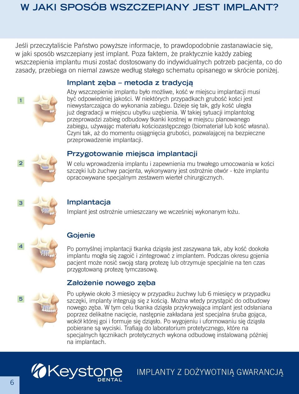skrócie poniżej. 1 Implant zęba metoda z tradycją Aby wszczepienie implantu było możliwe, kość w miejscu implantacji musi być odpowiedniej jakości.