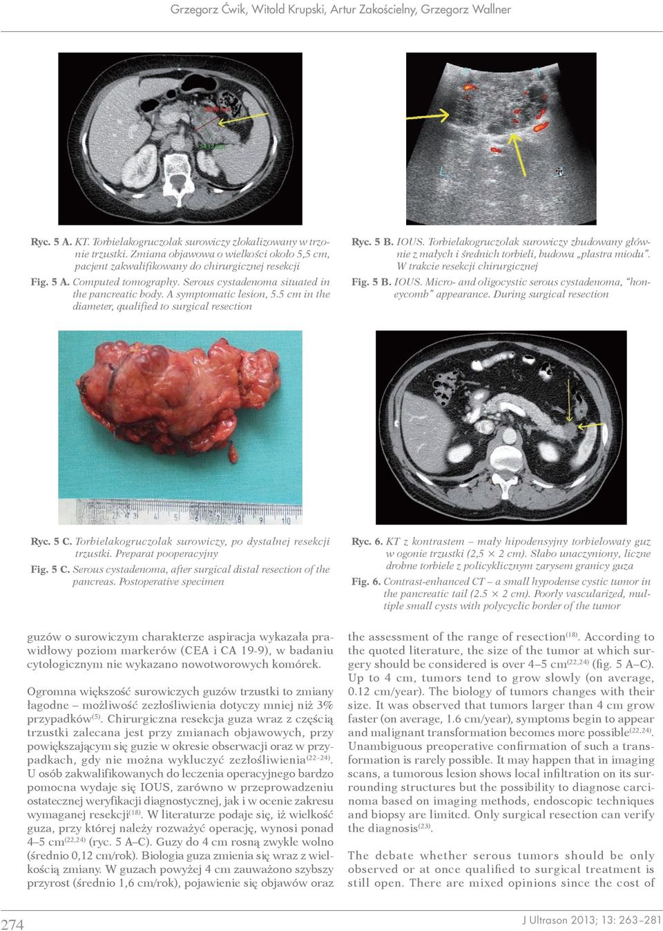 5 cm in the diameter, qualified to surgical resection Ryc. 5 B. IOUS. Torbielakogruczolak surowiczy zbudowany głównie z małych i średnich torbieli, budowa plastra miodu.