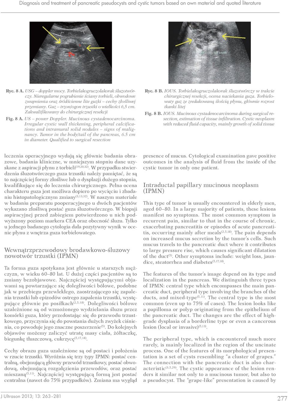 Zakwalifikowany do chirurgicznej resekcji Fig. 8 A. US power Doppler. Mucinous cystadenocarcinoma.