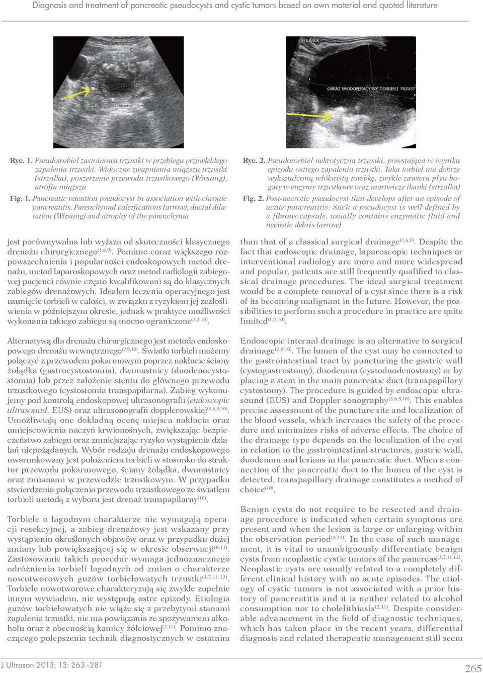 Parenchymal calcifications (arrow), ductal dilatation (Wirsung) and atrophy of the parenchyma jest porównywalna lub wyższa od skuteczności klasycznego drenażu chirurgicznego (1,6,9).