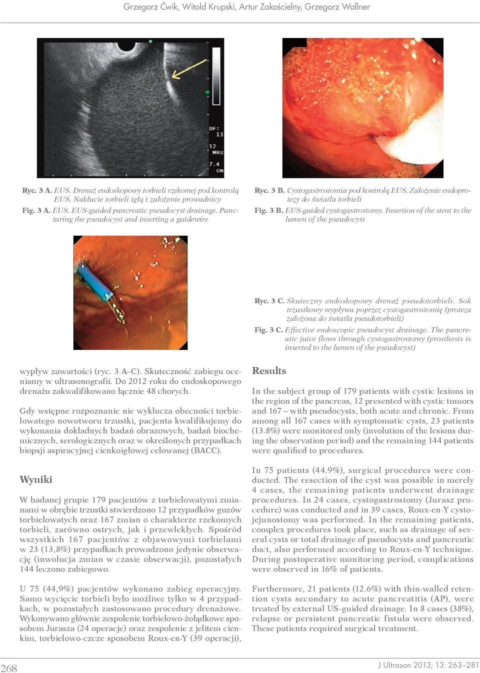 Insertion of the stent to the lumen of the pseudocyst Ryc. 3 C. Skuteczny endoskopowy drenaż pseudotorbieli.
