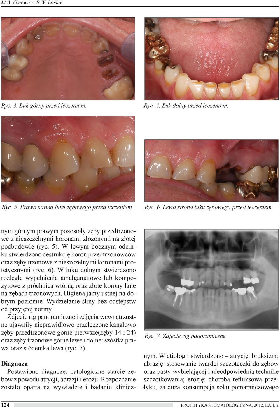 W lewym bocznym odcinku stwierdzono destrukcję koron przedtrzonowców oraz zęby trzonowe z nieszczelnymi koronami protetycznymi (ryc. 6).