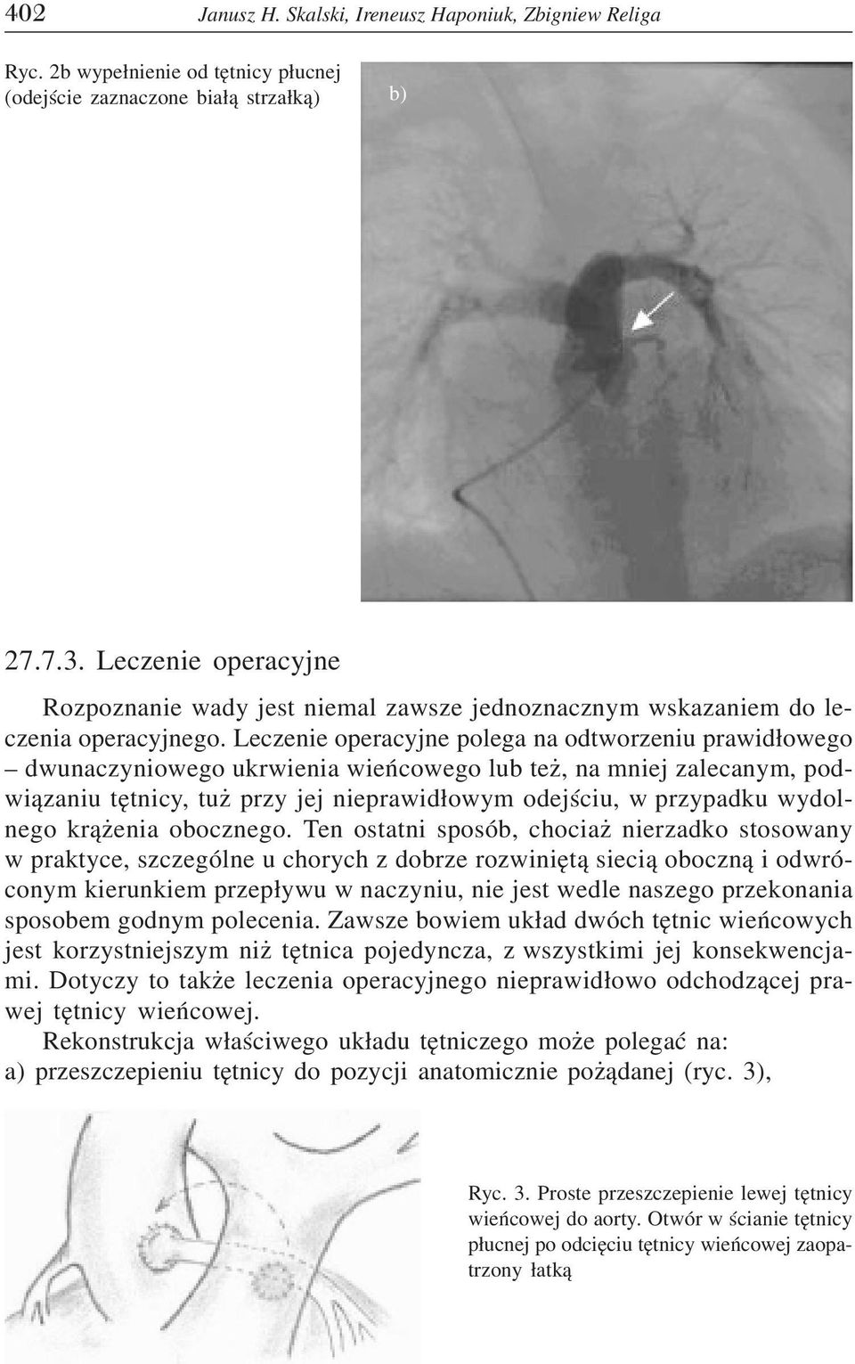 Leczenie operacyjne polega na odtworzeniu prawid³owego dwunaczyniowego ukrwienia wieñcowego lub te, na mniej zalecanym, podwi¹zaniu têtnicy, tu przy jej nieprawid³owym odejœciu, w przypadku wydolnego