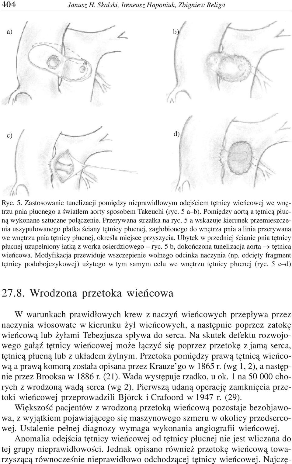 Pomiêdzy aort¹ a têtnic¹ p³ucn¹ wykonane sztuczne po³¹czenie. Przerywana strza³ka na ryc.