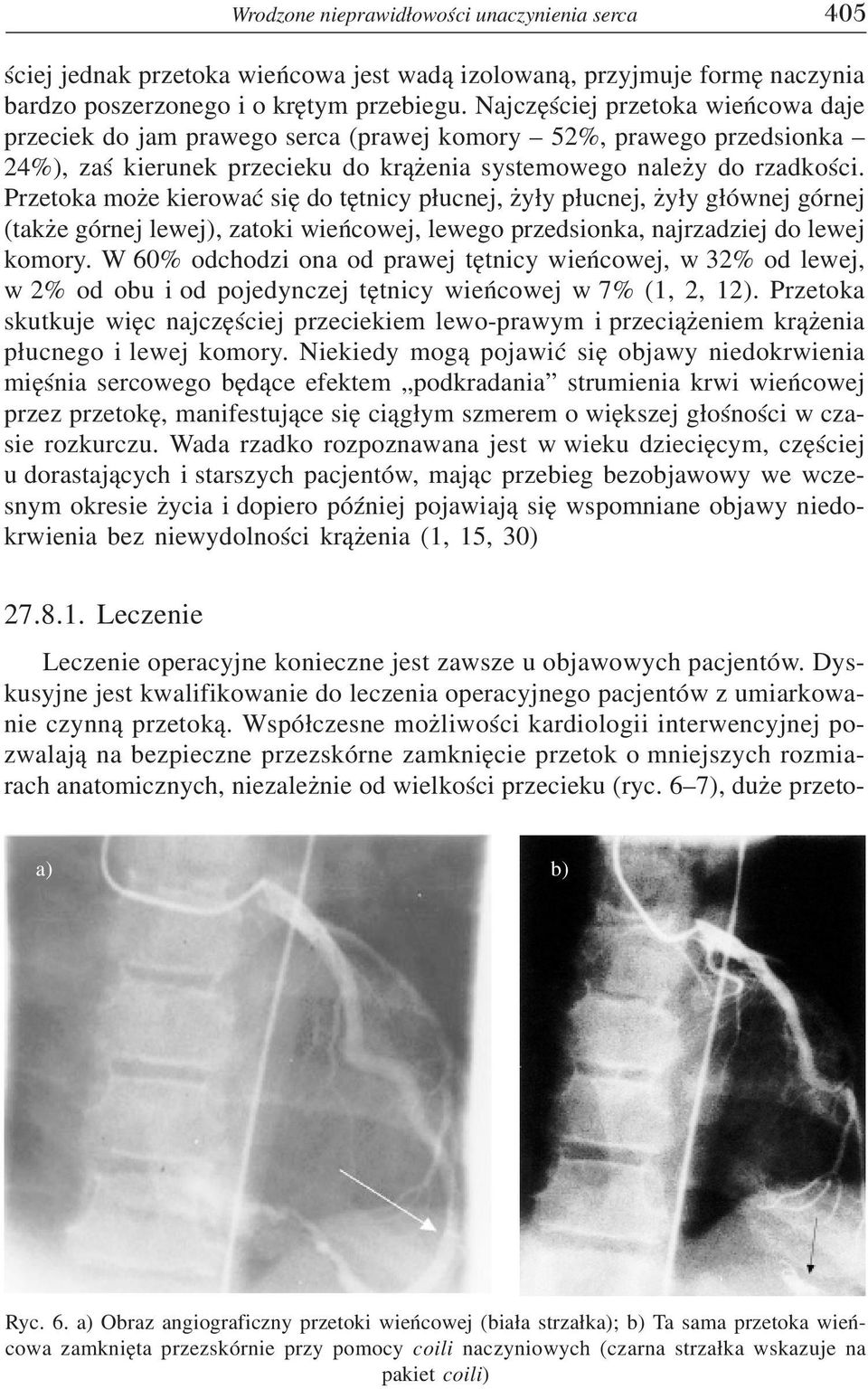 Przetoka mo e kierowaæ siê do têtnicy p³ucnej, y³y p³ucnej, y³y g³ównej górnej (tak e górnej lewej), zatoki wieñcowej, lewego przedsionka, najrzadziej do lewej komory.