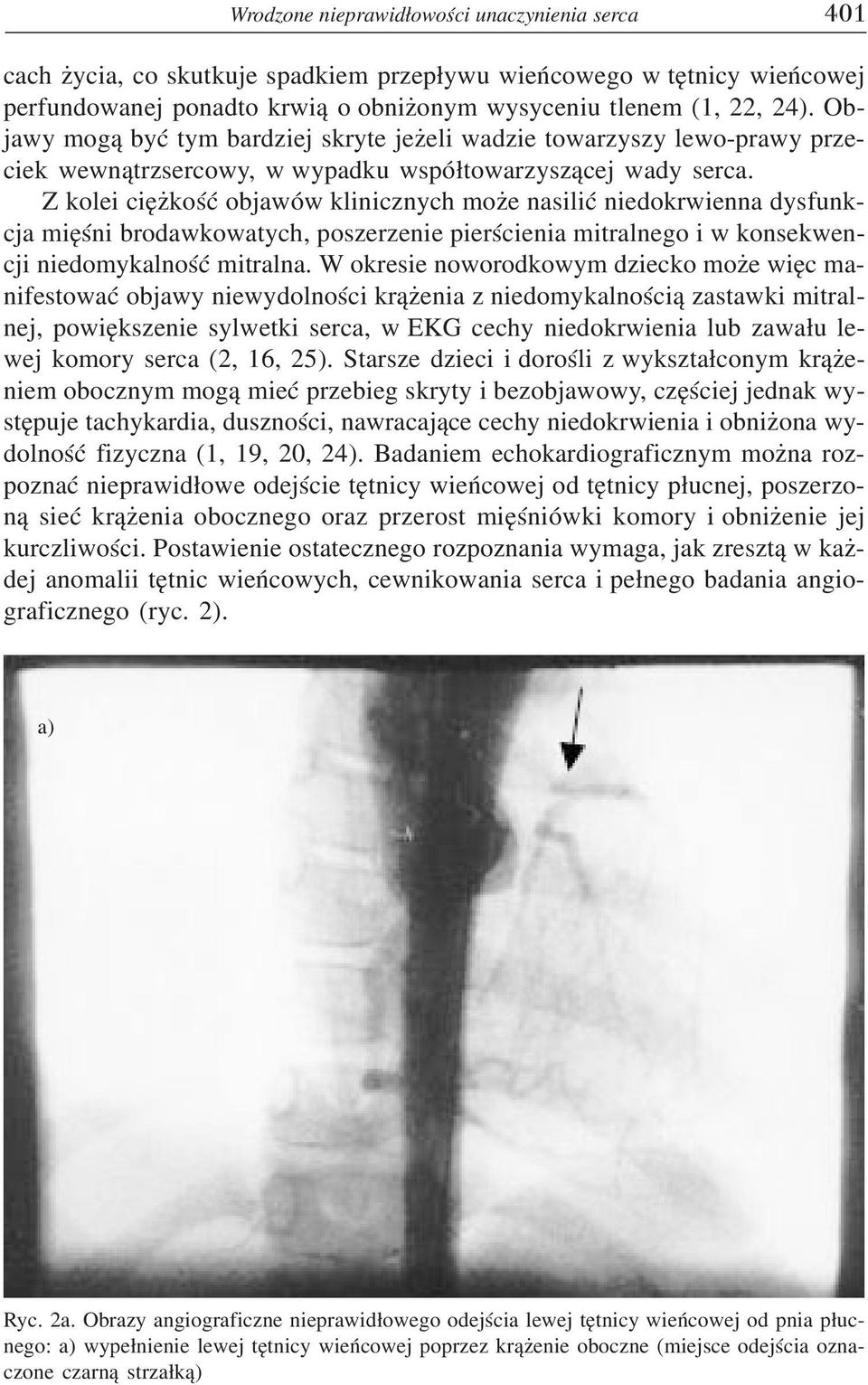 Z kolei ciê koœæ objawów klinicznych mo e nasiliæ niedokrwienna dysfunkcja miêœni brodawkowatych, poszerzenie pierœcienia mitralnego i w konsekwencji niedomykalnoœæ mitralna.