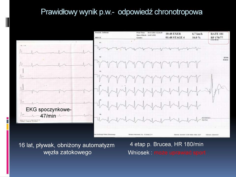 pływak, obniżony automatyzm węzła zatokowego