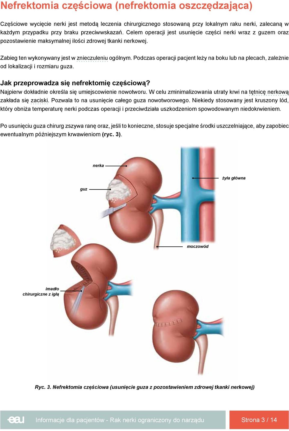 Podczas operacji pacjent leży na boku lub na plecach, zależnie od lokalizacji i rozmiaru guza. Jak przeprowadza się nefrektomię częściową? Najpierw dokładnie określa się umiejscowienie nowotworu.