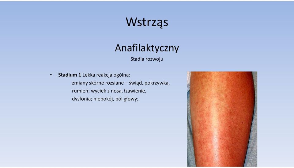 skórne rozsiane świąd, pokrzywka, rumień;
