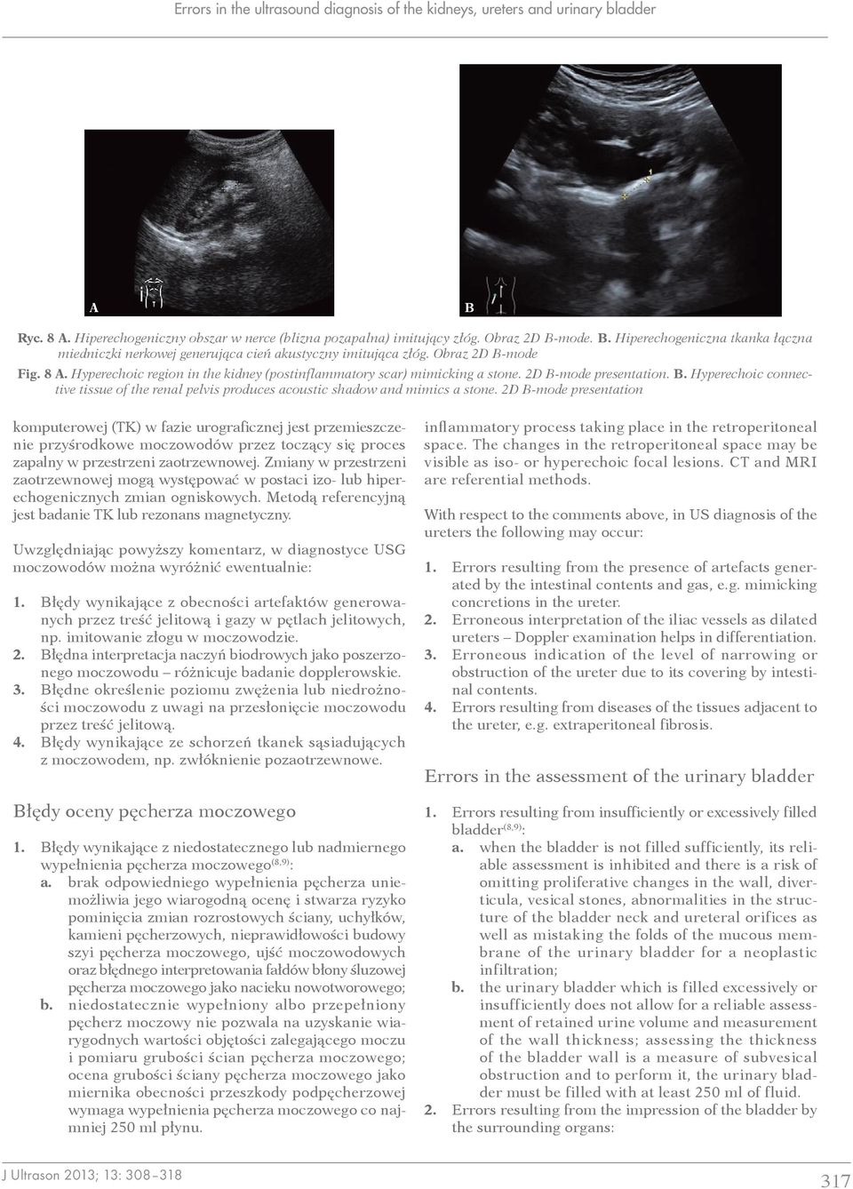 2D -mode presentation.. Hyperechoic connective tissue of the renal pelvis produces acoustic shadow and mimics a stone.
