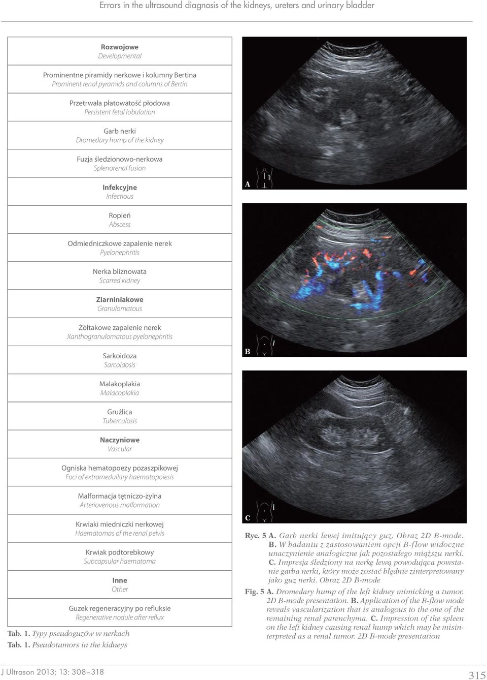 zapalenie nerek Pyelonephritis Nerka bliznowata Scarred kidney Ziarniniakowe Granulomatous Żółtakowe zapalenie nerek Xanthogranulomatous pyelonephritis Sarkoidoza Sarcoidosis Malakoplakia