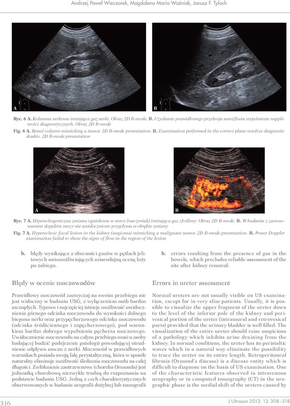 . Examination performed in the correct plane resolves diagnostic doubts. 2D -mode presentation Ryc. 7. Hiperechogeniczna zmiana ogniskowa w nerce (naczyniak) imitująca guz złośliwy. Obraz 2D -mode.