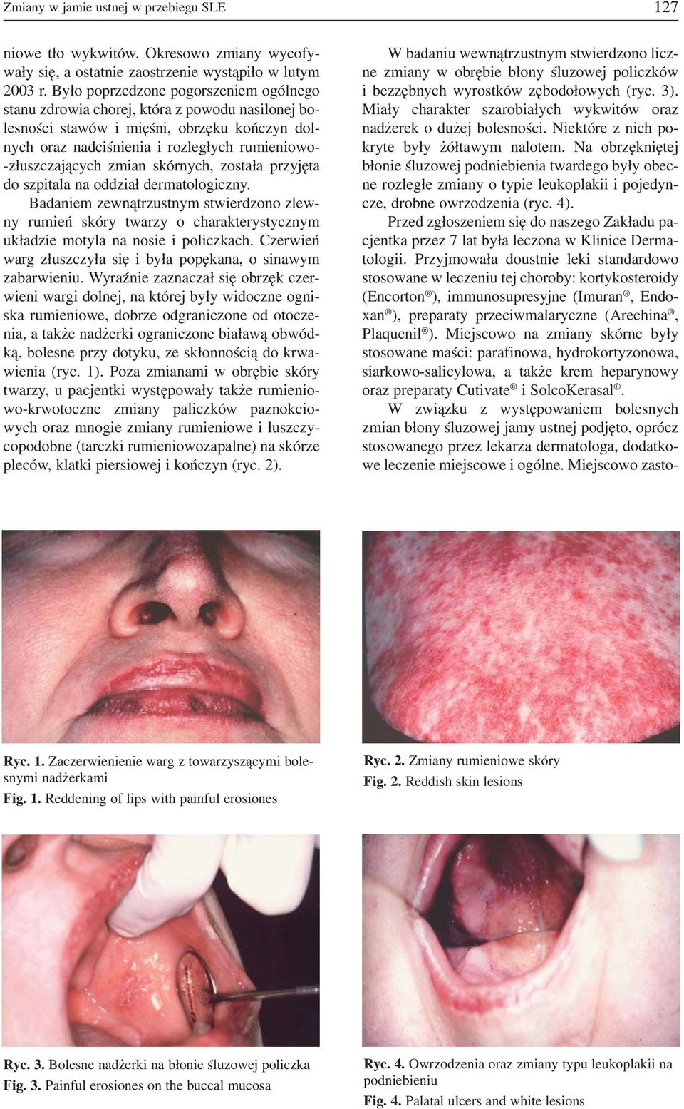 zmian skórnych, została przyjęta do szpitala na oddział dermatologiczny. Badaniem zewnątrzustnym stwierdzono zlew ny rumień skóry twarzy o charakterystycznym układzie motyla na nosie i policzkach.