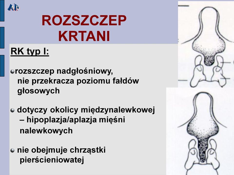 okolicy międzynalewkowej hipoplazja/aplazja mięśni