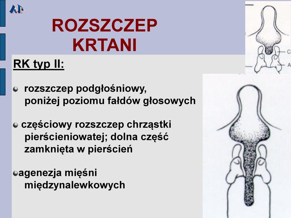 częściowy rozszczep chrząstki pierścieniowatej;
