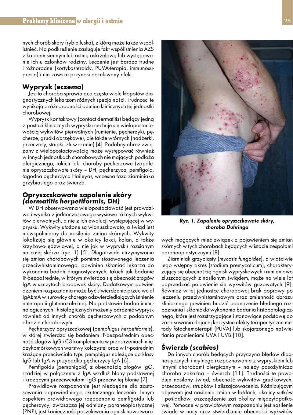 Leczenie jest bardzo trudne i różnorodne (kortykosteroidy, PUVA-terapia, immunosupresja) i nie zawsze przynosi oczekiwany efekt.