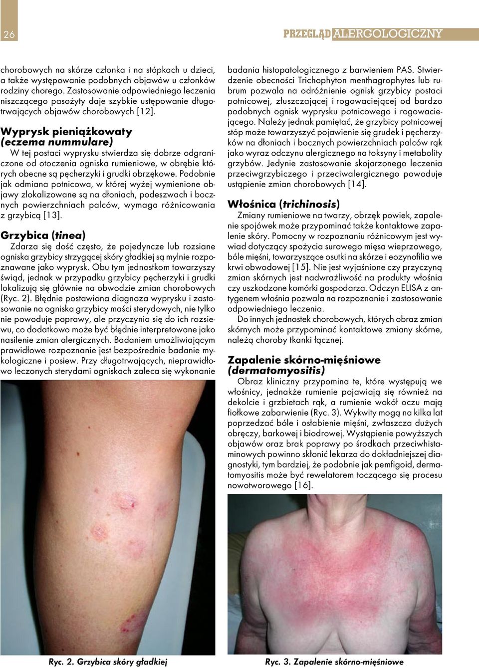Wyprysk pieniążkowaty (eczema nummulare) W tej postaci wyprysku stwierdza się dobrze odgraniczone od otoczenia ogniska rumieniowe, w obrębie których obecne są pęcherzyki i grudki obrzękowe.