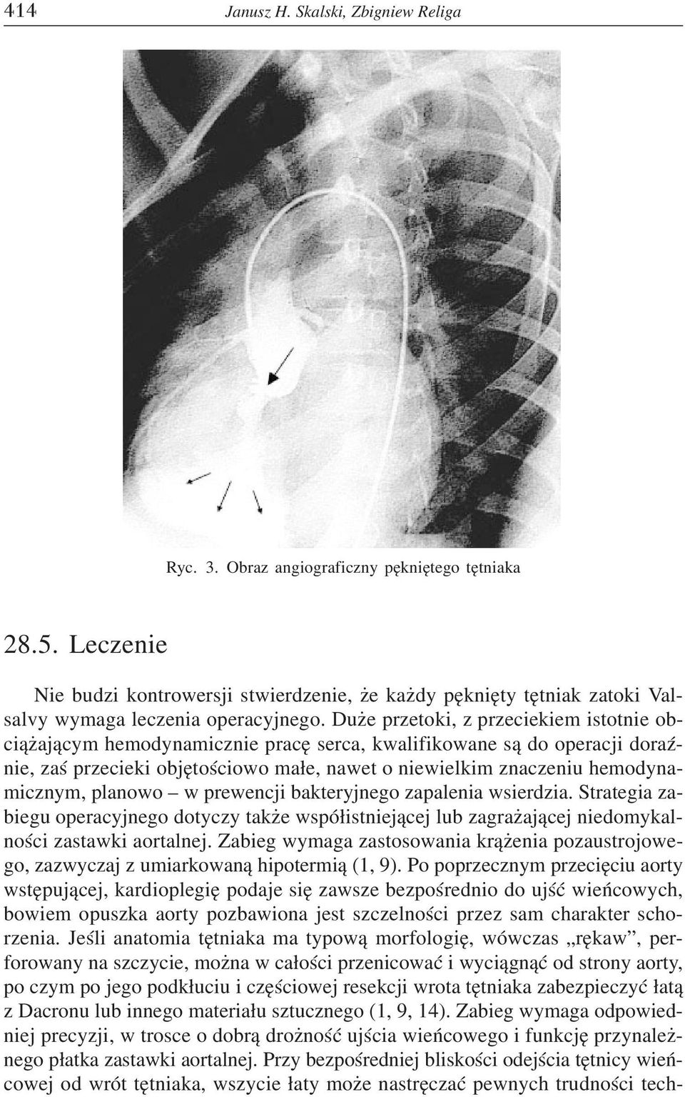 Du e przetoki, z przeciekiem istotnie obci¹ aj¹cym hemodynamicznie pracê serca, kwalifikowane s¹ do operacji doraÿnie, zaœ przecieki objêtoœciowo ma³e, nawet o niewielkim znaczeniu hemodynamicznym,