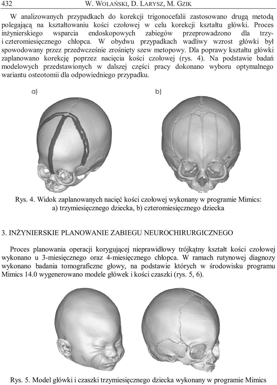 W obydwu przypadkach wadliwy wzrost główki był spowodowany przez przedwcześnie zrośnięty szew metopowy. Dla poprawy kształtu główki zaplanowano korekcję poprzez nacięcia kości czołowej (rys. 4).