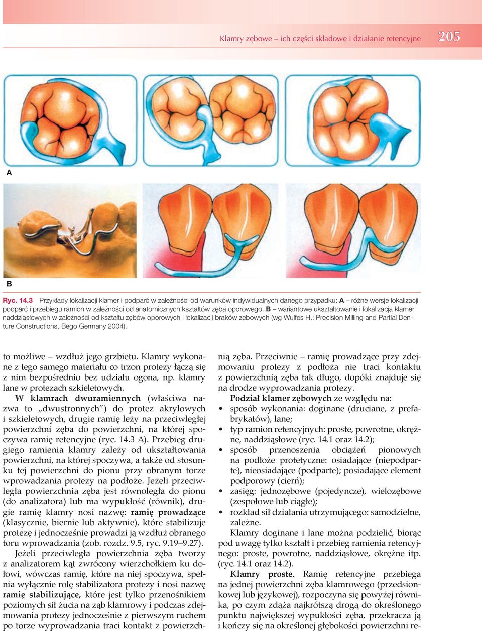 B wrintowe uksztłtownie i loklizj klmer nddziąsłowyh w zleżnośi od ksztłtu zęów oporowyh i loklizji rków zęowyh (wg Wulfes H.: Preision Milling nd Prtil Denture Construtions, Bego Germny 2004).