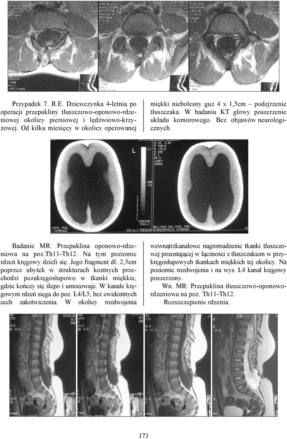Badanie MR: Przepuklina oponowo-rdzeniowa na poz.th11-th12. Na tym poziomie rdzeń kręgowy dzieli się. Jego fragment dł.