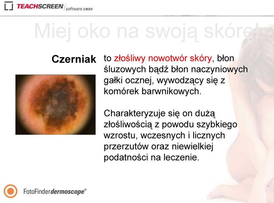 Charakteryzuje się on dużą złośliwością z powodu szybkiego