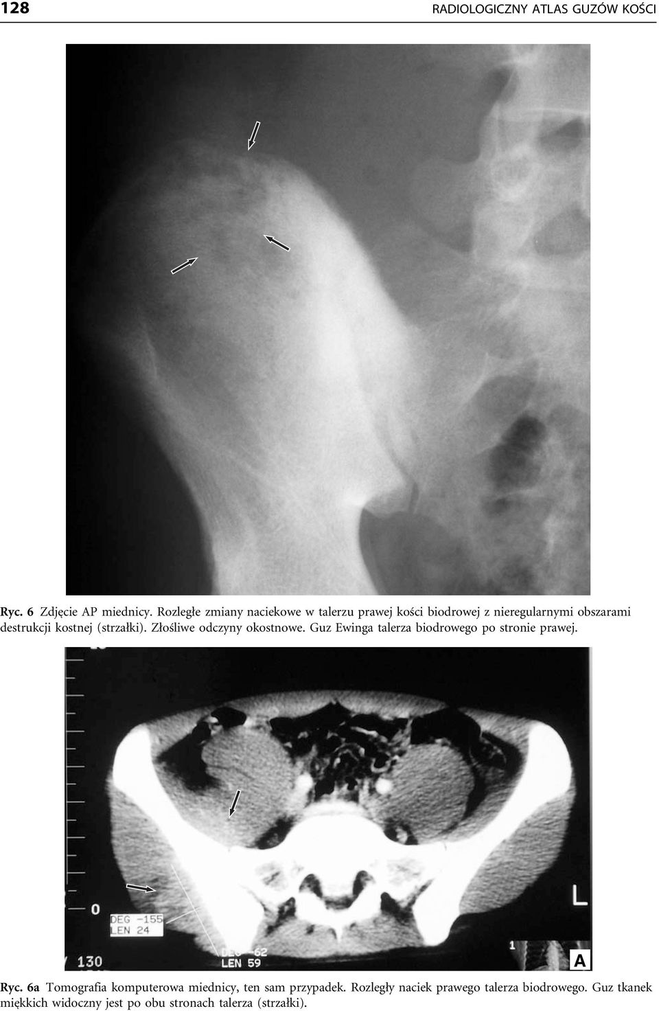 (strzałki). Złośliwe odczyny okostnowe. Guz Ewinga talerza biodrowego po stronie prawej. Ryc.
